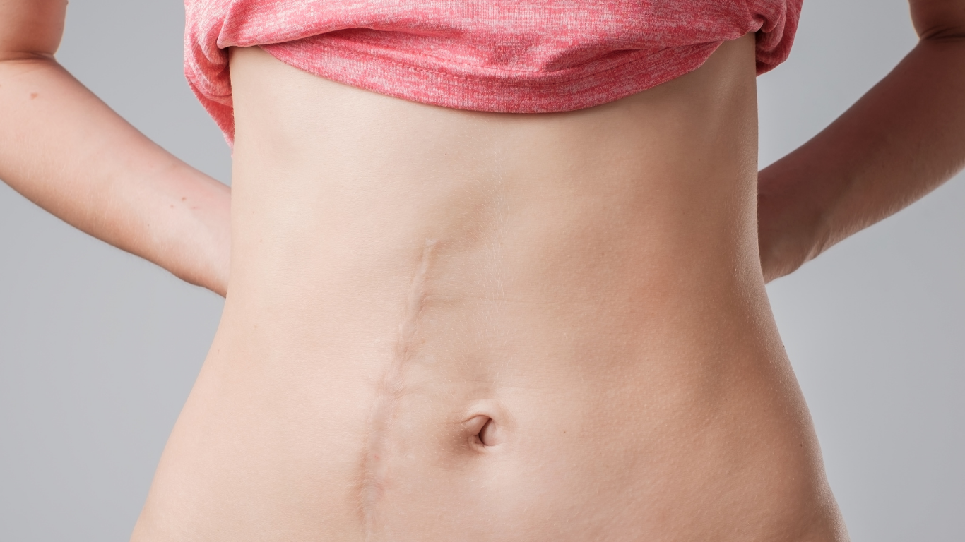 Abdominal Cerrahi, Reiki Anksiyete,Korku, Ağrı,Yaşam kalitesi Uzman Yardımı Alın