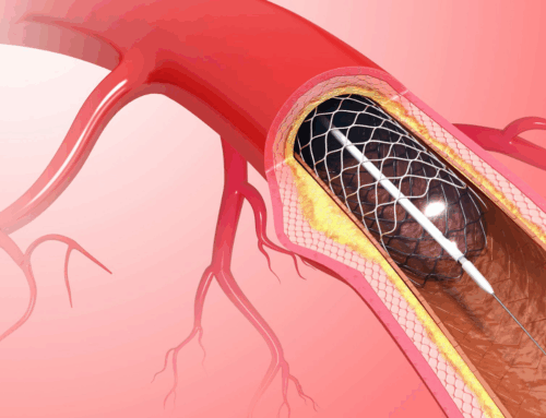 Perkütan koroner girişim sonrası Reiki’nin ağrı, anksiyete ve yaşam bulgularına etkisi